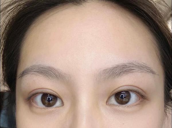 17岁眼皮松弛怎么恢复(17岁眼皮松弛恢复法)